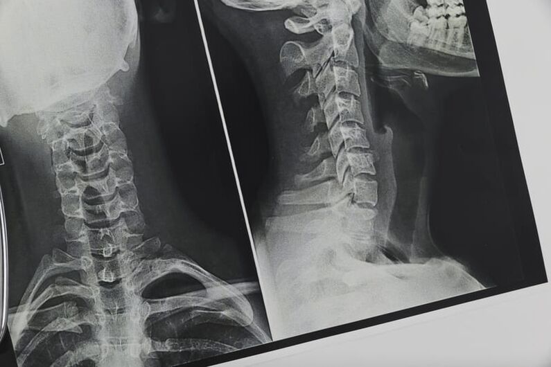 Zdjęcie rentgenowskie kręgosłupa szyjnego dotkniętego osteochondrozą