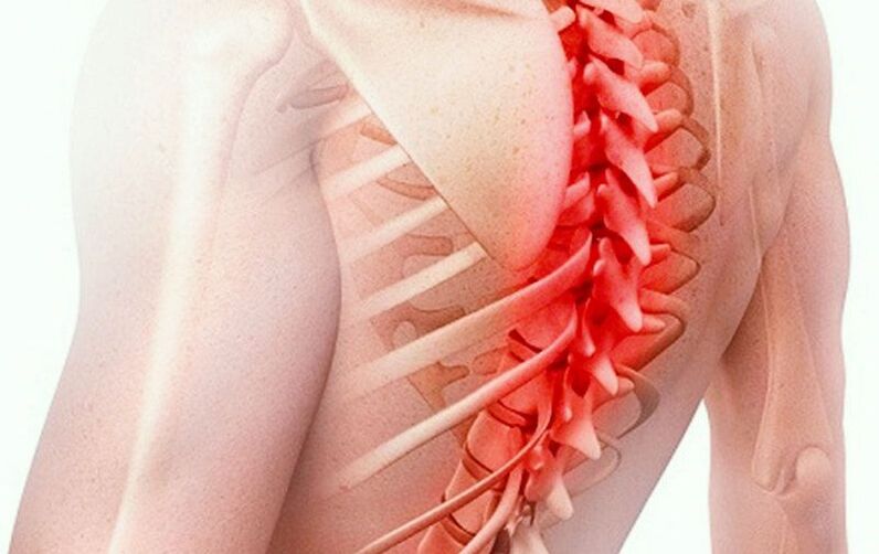 osteochondroza kręgosłupa piersiowego