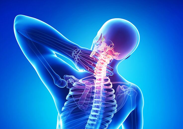 Osteochondroza kręgosłupa jest chorobą atakującą chrząstkę stawową i kręgi.