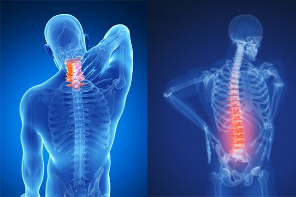 Osteochondroza kręgosłupa szyjnego i lędźwiowego