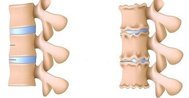 Jak rozpoznać obecność osteochondrozy lędźwiowej