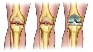 endoprotetyka w przypadku artrozy stawu kolanowego